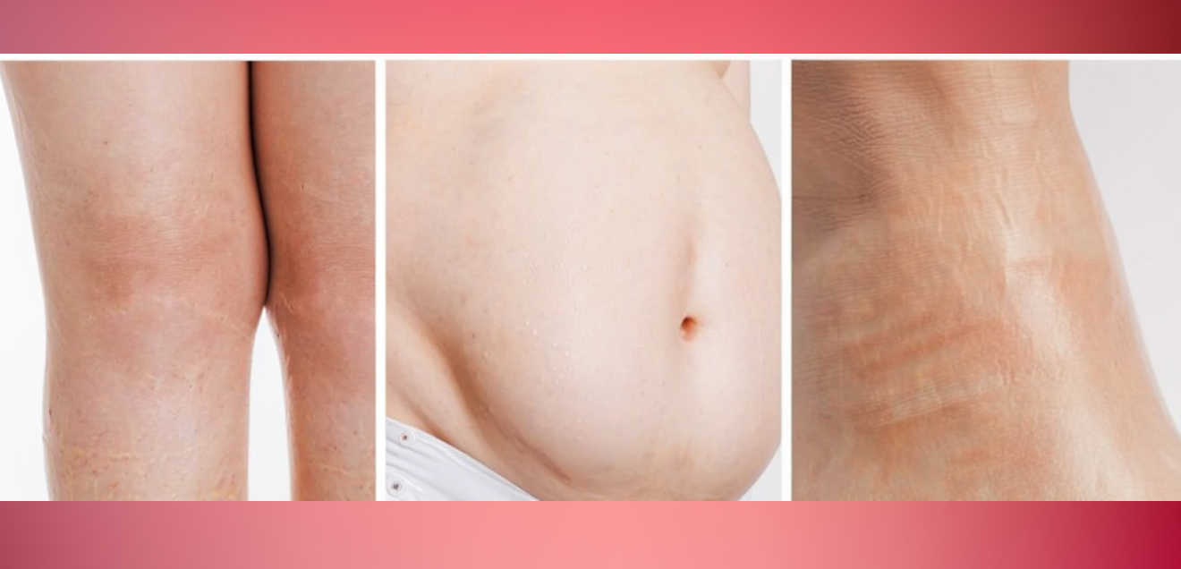 Mixedema: quando la bilancia mente (e la tiroide chiede aiuto)