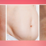 Mixedema: quando la bilancia mente (e la tiroide chiede aiuto)